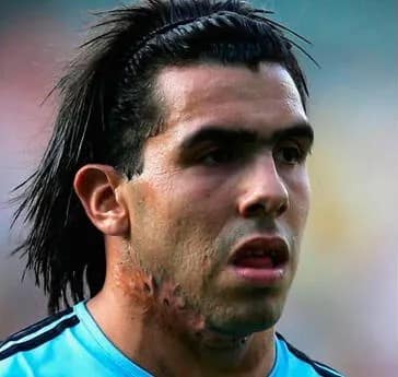 Bilde av fotballspilleren Carlos Tevez som viser synlige arr på høyre kjeveparti.